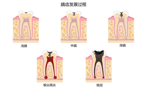 摄图网_401808342_龋齿发展过程口腔医学配图（非企业商用）_副本.jpg