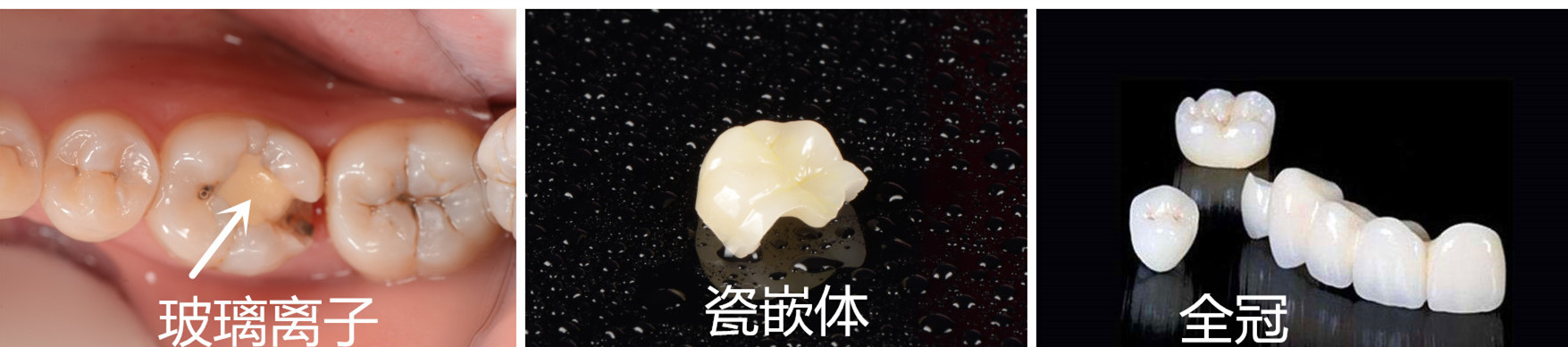 4全瓷嵌体_副本_副本.jpg