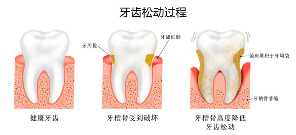 牙齿松动过程_副本.jpg